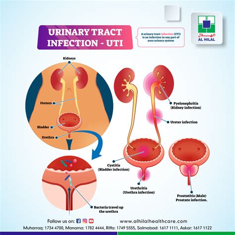 Urinary Tract Infection (UTI) - open.byu.edu