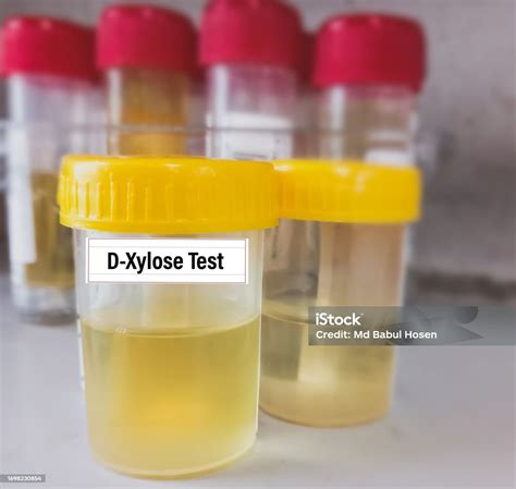 Urine Sample For Xylose Test To Help Diagnose Malabsorption Disorders