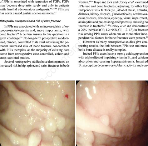 Use of Proton Pump Inhibitors and Risks of Fundic Gland Polyps …