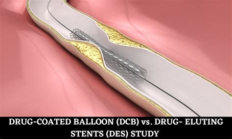 Use of drug-coated balloon instead of drug-eluting stent …