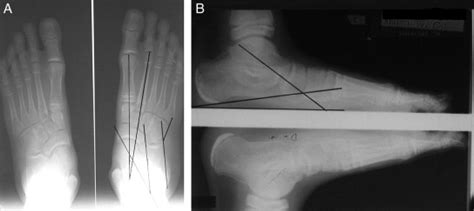 Use of the Maxwell-Brancheau Arthroereisis Implant for the …