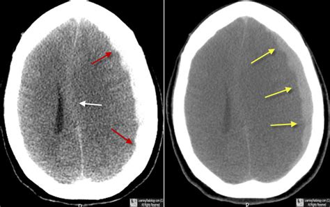 Using Subdural Windows for Detecting Hemorrhage on ...