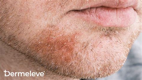 Discover the benefits and risks of hydrocortisone cream for facial use in our informative article.