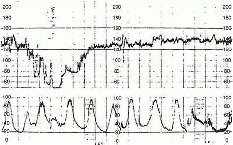 Uterine Contractions Obgyn Key