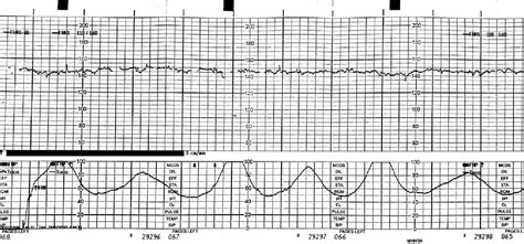 Uterine Tachysystole Reiter & Walsh