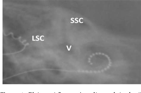 Utility of Intraoperative Radiographs in Pediatric Cochlear Implant ...