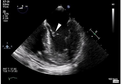 Utility of transesophageal echocardiography in the identification …