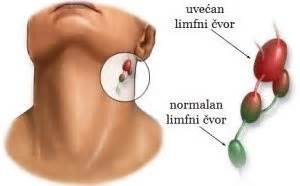Uvecane limfne zlezde na vratu. .