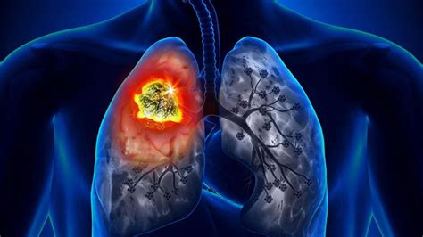 Uzmanlar açıkladı: ''Akciğer kanserlerinin yüzde 90’ının sebebi sigara''