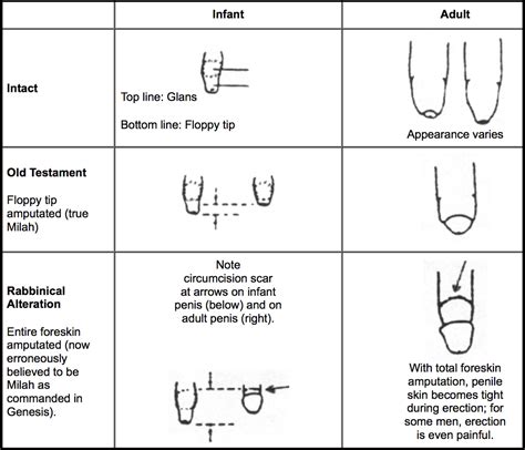 V cut circumcision. The Circumplast circumcision device has a cylindrical body, thus the distal opening of the device is the same diameter as the proximal opening. Contact for C... 