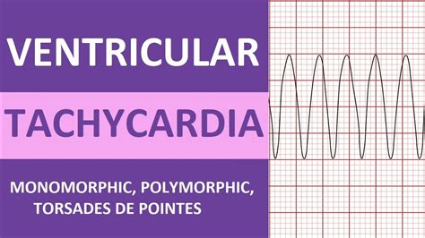 V tach definition of V tach by Medical dictionary