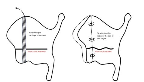 Voice Deepening Surgery in Turkey - Fibohealth - balustradellc