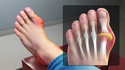 Va disability rating for gout. Things To Know About Va disability rating for gout. 