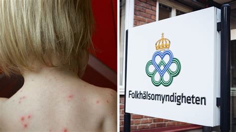Vaccination vattkoppor