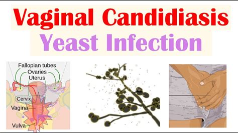 Vaginal thrush (candida or yeast infection) Jean Hailes