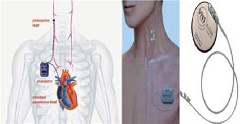 Vagus Nerve Stimulation - ScienceDirect