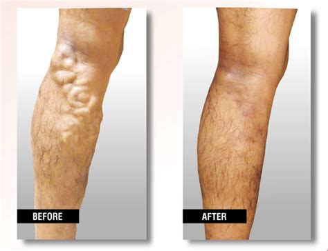 Varicose Vein Treatments for Queens, NY USA Vein Clinics