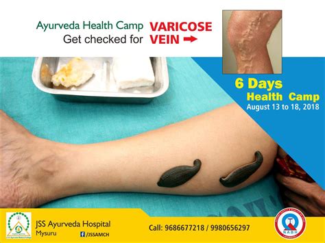 Varicose Veins Treatment in Ayurveda Learn Ayurveda