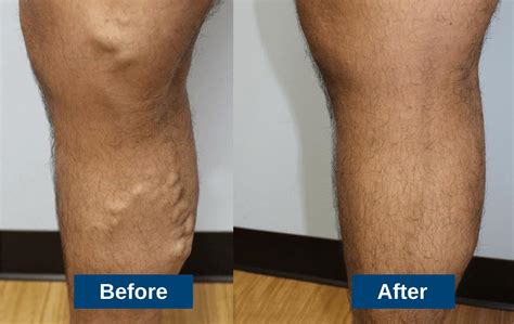 We offer patients a variety of varicose vein treatment procedures that seal off veins with unhealthy valves. Blood circulation then returns to the veins with properly working valves, and closed veins are eventually absorbed …. 