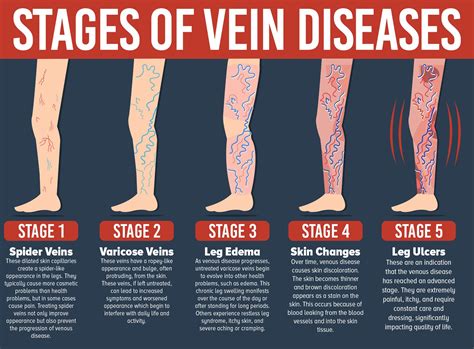 Varicose veins - Diagnosis - NHS