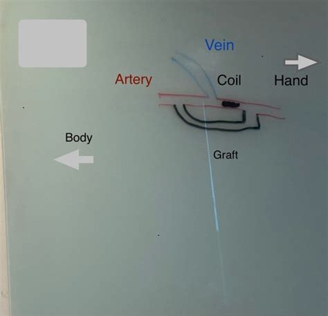 Vascular Access - Fistula Flashcards Quizlet