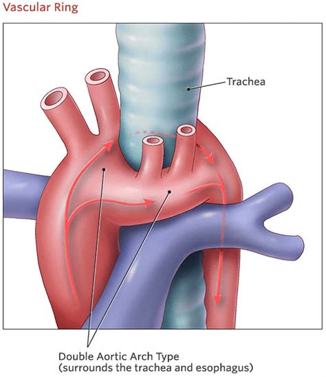 Vascular Ring Surgery and Double Aortic Arch - Find-A-Code