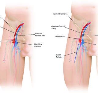 Vascular access device insertion.  In the common femoral artery access...