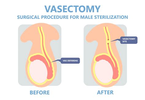 Vasectomy after one child.  #MaternalHealth #ProtectWomen #PostpartumCare #Resp...