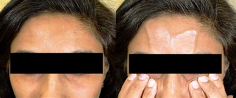 Vein in forehead when smiling