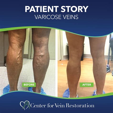 Vein restoration. Center for Vein Restoration operates multiple vein centers in Virginia. Our vein treatment providers will determine a treatment plan for varicose veins & other symptoms of vein disease. Find a vein clinic near you and schedule a vein evaluation today. 