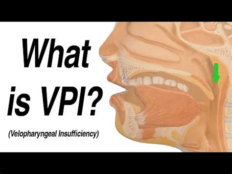 Velopharyngeal Insufficiency (VPI) – Stanford …