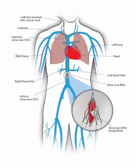 Vena Cava Filter Placement: What to Expect at Home - Alberta