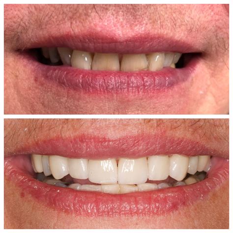 Veneers Smith & Co. Dental Practitioners Bel Air, MD