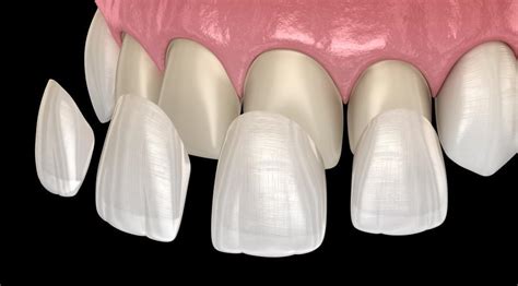 Venners - Porcelain Veneers: Before and After Pictures. Porcelain veneers are custom-made, thin shells. They improve your smile by changing the shape, color, and overall look of your teeth. 3. These veneers are strong and long-lasting. They’re also stain-resistant and offer a natural look.