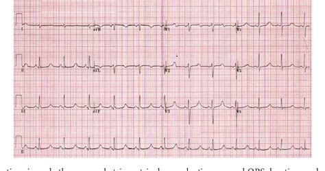 Ventricular Arrhythmia Precipitated by Severe Hypocalcaemia