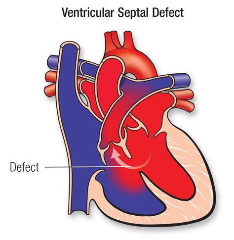 Ventricular Septal Defect (Child) - KK Women