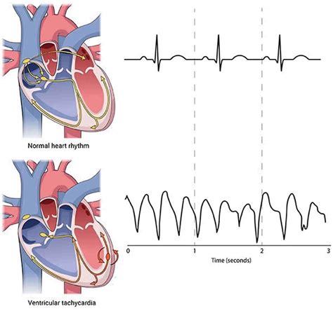 Ventricular tachycardia Definition & Meaning Merriam …