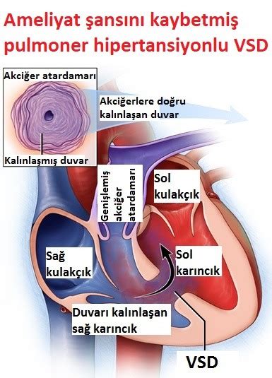 Ventriküler Septal Defekt (VSD) Prof. Dr. Ahmet Şaşmazel. 