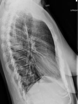 Vertebral hemangioma Radiology Case Radiopaedia.org