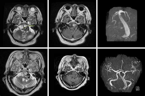 Vertebrobasilar dolichoectasia mri. In this study, we present a case with multiple episodes o...