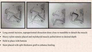 Vestibuloplasty - SlideShare