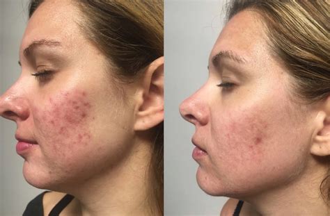 VI Peel, the leader in painless and skin-tone inclusive corrective chemical peels, announces revolutionary new study findings published in the prestigious Journal of Drugs in Dermatology (JDD ...