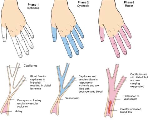 Viagra okay as treatment of Raynaud