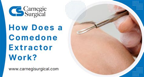 Video of comedone extraction.  Warning: You probably shouldn’t watch ...