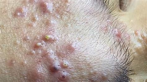 Subscribe to REALLY for more great clips: https://bit.ly/3kuIVkVReed has been bothered with eruptive vellus hair cysts since he was 17, and the only way for .... 