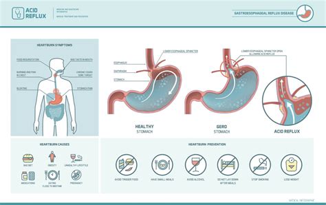 View Does Maalox Help Gerd Pictures How To Eliminate Gerd Naturally