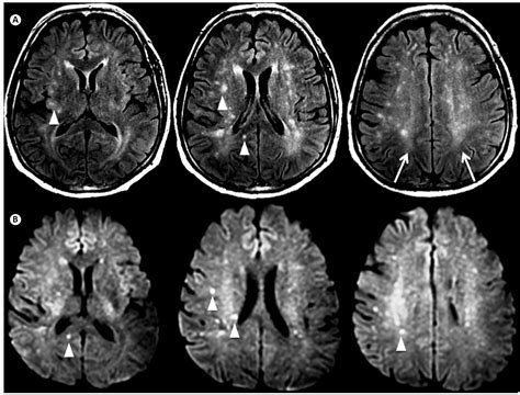 Viral encephalitis - SciELO