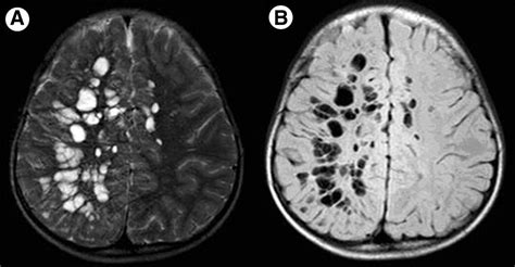 Virchow-Robin Spaces in Cerebral Imaging: Relationship of.