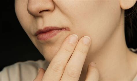 Vitamin B deficiency symptoms include angular cheilitis - cracked …