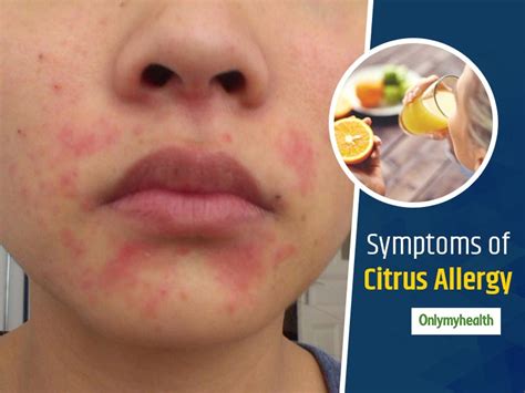 Vitamin c allergy symptoms. Things To Know About Vitamin c allergy symptoms. 